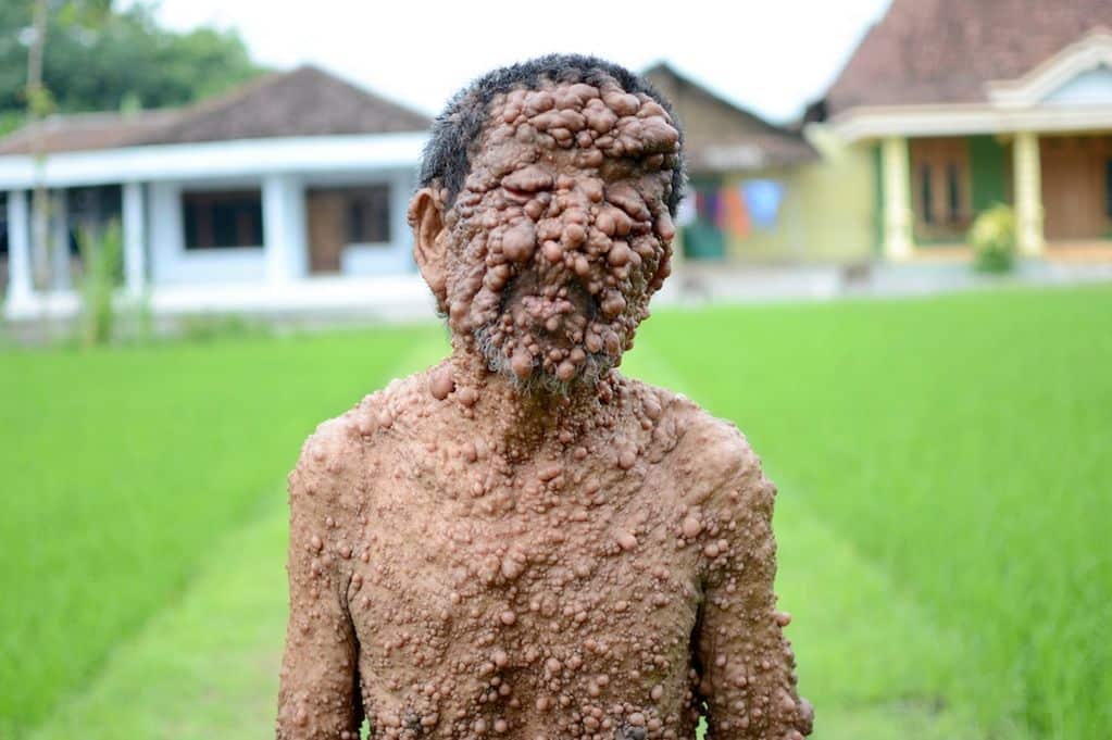 10 Rare Diseases That You Wish Were Not Real!