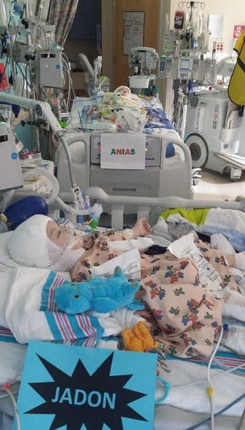 Praise God: Twins Conjoined At The Torso Successfully 