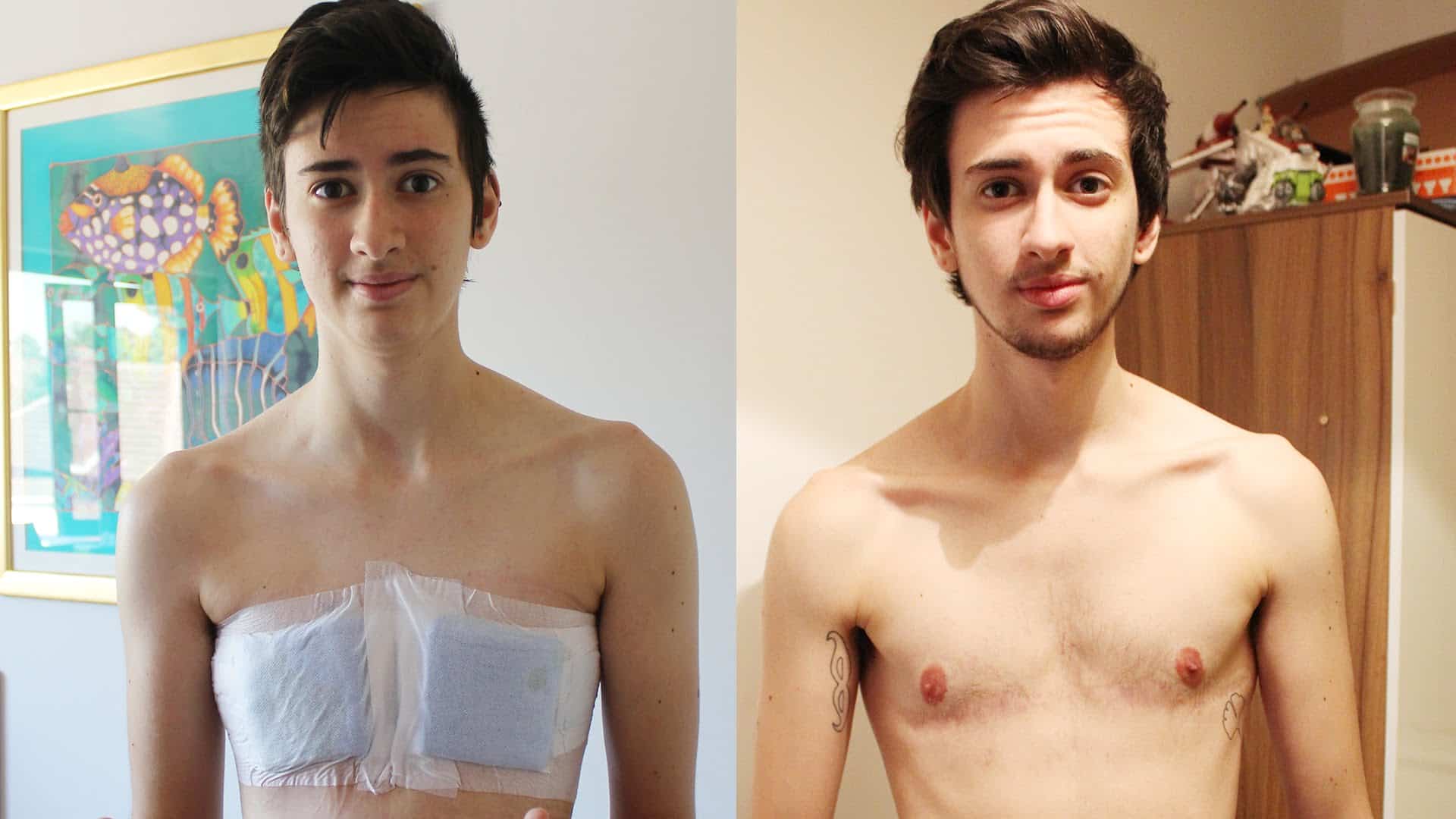 gender reassignment surgery before and after ftm