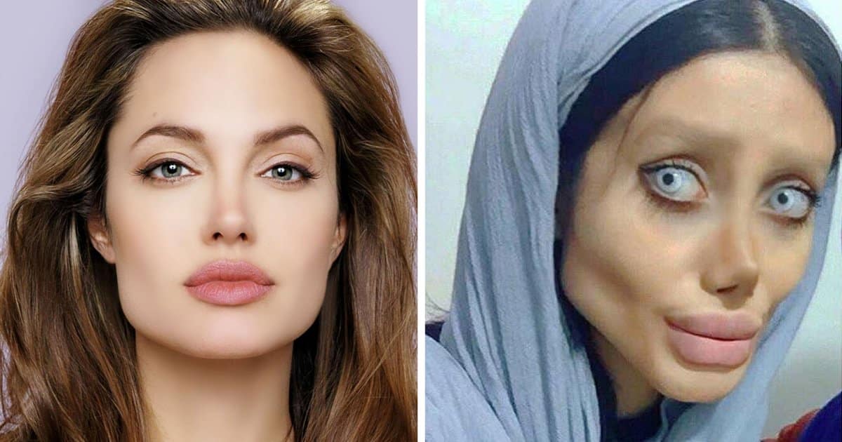 Iranian Teen Who Underwent 50 Surgeries To Look Like