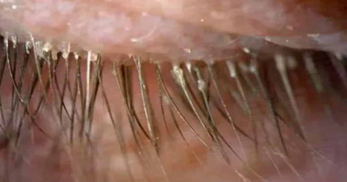 This Woman Found 100 Mites In Her Eyes After Not Washing ...